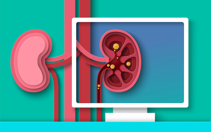Kidney stones disease examination and diagnosis paper cut 3d vector. Human anatomy of sick internal organ cross section design. Urology, nephrology surgery concept. Health care and medicine