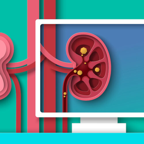 Kidney stones disease examination and diagnosis paper cut 3d vector. Human anatomy of sick internal organ cross section design. Urology, nephrology surgery concept. Health care and medicine